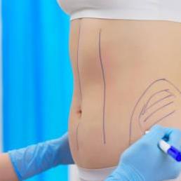 Liposuction  In Riyadh